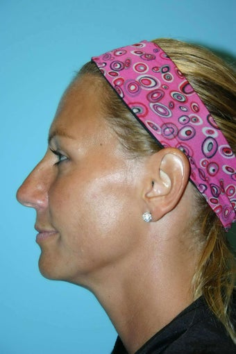 46 Year Old Female treated for neck laxity with Ultherapy after 1056616