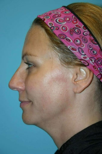 46 Year Old Female treated for neck laxity with Ultherapy before 1056616