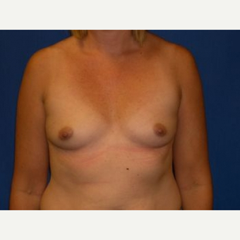 25-34 year old woman treated with Breast Augmentation before 3009226