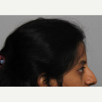 35-44 year old woman treated with Rhinoplasty before 3424433