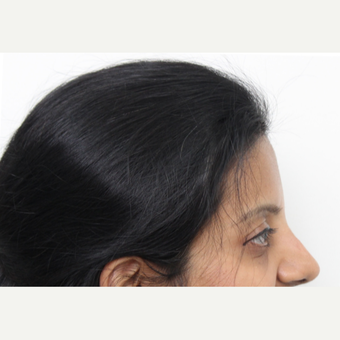 35-44 year old woman treated with Rhinoplasty after 3424433