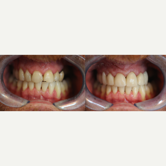 Smile makeover with Enlighten Whitening + 6 Cerac Crowns before 3174486