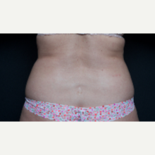 45-54 year old woman treated with SculpSure to abdomen and lovehandles before 3646525