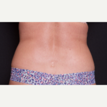 45-54 year old woman treated with SculpSure to abdomen and lovehandles after 3646525