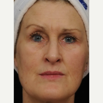 45-54 year old woman treated with Fraxel Laser after 2172403