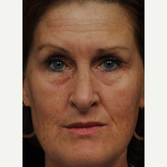 45-54 year old woman treated with Fraxel Laser before 2172403