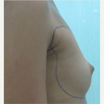18-24 year old woman treated with Breast Fat Transfer before 3073355
