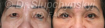 Upper Eyelid Lift before 1117195