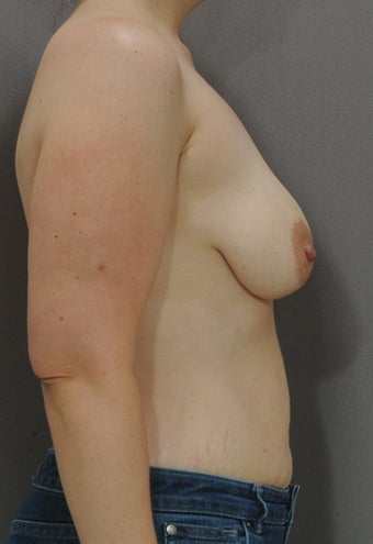 32 year old female. Silicone implants- 397 x 2. 1245997