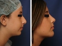 Rhinoplasty and chin implant before 130773