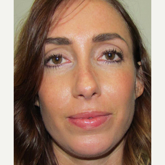 Septoplasty for this 34 Year Old Woman after 3168983