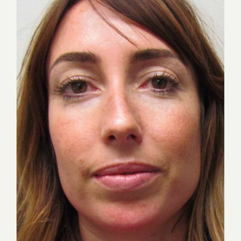 Septoplasty for this 34 Year Old Woman before 3168983