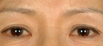 Asian Eyelid Surgery before 1208025