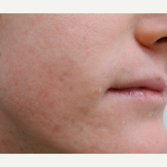 Acne after 3679292