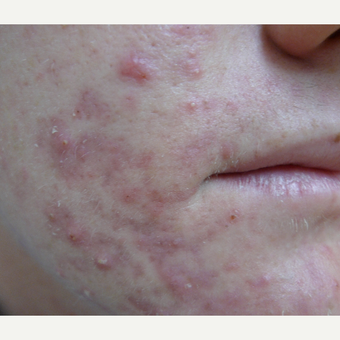 Acne before 3679292