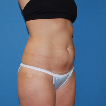 25-34 year old woman treated with SculpSure before 3454359