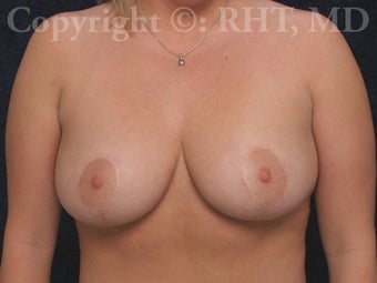Breast Lift (mastopexy) after 254525