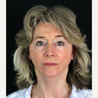 55-64 year old woman treated with Lower Face Lift after 2840464