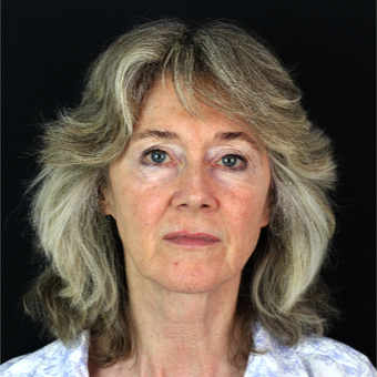 55-64 year old woman treated with Lower Face Lift before 2840464