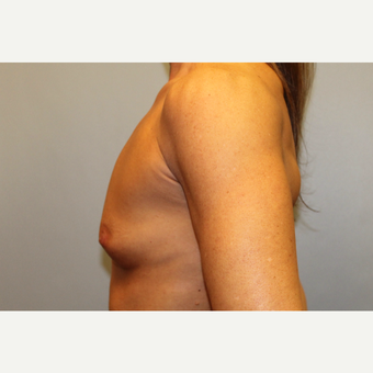 45-54 year old woman treated with Breast Augmentation before 3569560