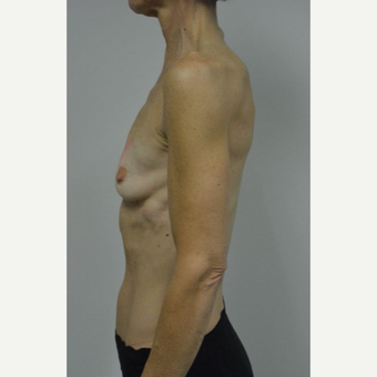 55-64 year old woman treated with Breast Augmentation before 3054981