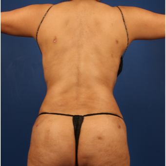 35-44 year old woman treated with Liposuction after 3596495