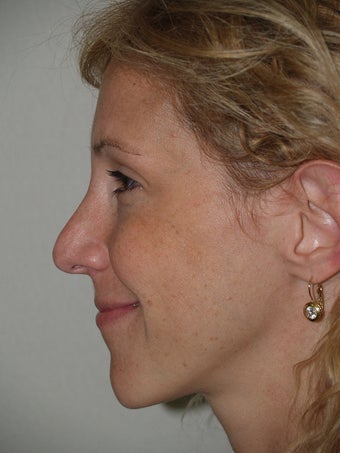 Revision Rhinoplasty before 173207