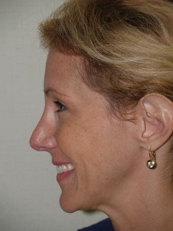 Revision Rhinoplasty after 173207