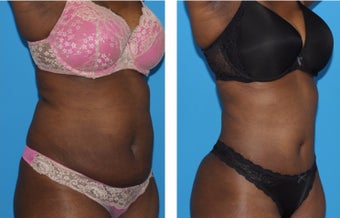 35-44 year old woman treated with Tummy Tuck after 2773943