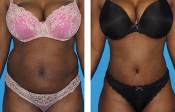 35-44 year old woman treated with Tummy Tuck before 2773943