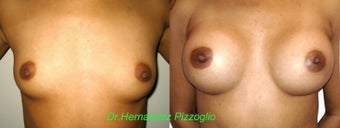 Breast Augmentation before 1210627