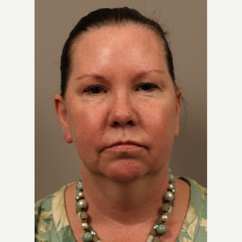55 year old woman treated with Facelift including fat contouring before 3027580