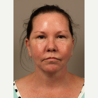 55 year old woman treated with Facelift including fat contouring after 3027580