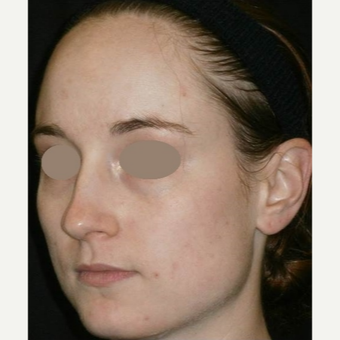 25-34 year old woman treated with Chemical Peel after 3123248