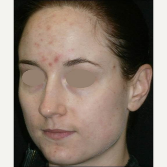 25-34 year old woman treated with Chemical Peel before 3123248