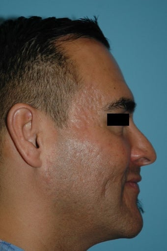 25-34 year old man treated with Microneedling for acne scars 2882913