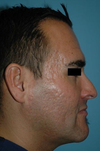 25-34 year old man treated with Microneedling for acne scars 2882913