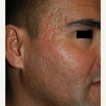 25-34 year old man treated with Microneedling for acne scars before 2882913