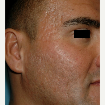 25-34 year old man treated with Microneedling for acne scars after 2882913