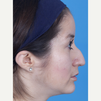 25-34 year old woman treated with Rhinoplasty before 3159517