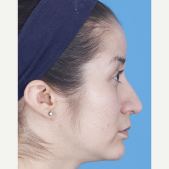 25-34 year old woman treated with Rhinoplasty after 3159517