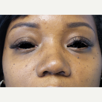 35-44 year old woman treated with African American Rhinoplasty after 3169304