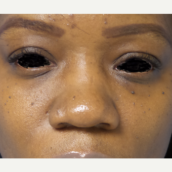 35-44 year old woman treated with African American Rhinoplasty before 3169304