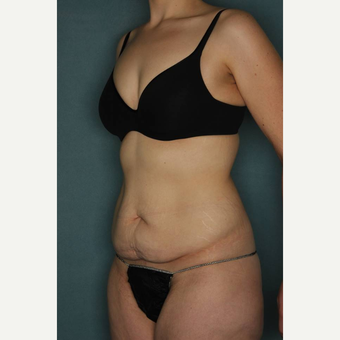 18-24 year old woman treated with Tummy Tuck before 3436187