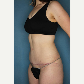 18-24 year old woman treated with Tummy Tuck after 3436187