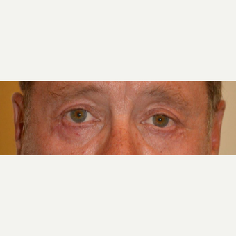 55-64 year old man treated with Eyelid Surgery after 3425581