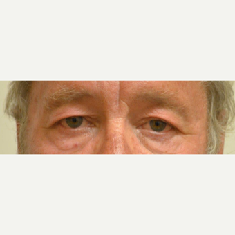 55-64 year old man treated with Eyelid Surgery before 3425581