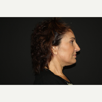 45-54 year old woman with Full Facelift, Open Brow Lift, Upper and Lower Blepharoplasty after 3028129