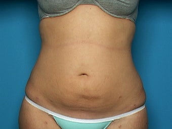 Liposuction of Abdomen, Hips, and Thighs after 136879