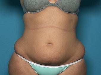 Liposuction of Abdomen, Hips, and Thighs before 136879
